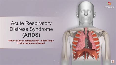 ards medical abbreviation stands for